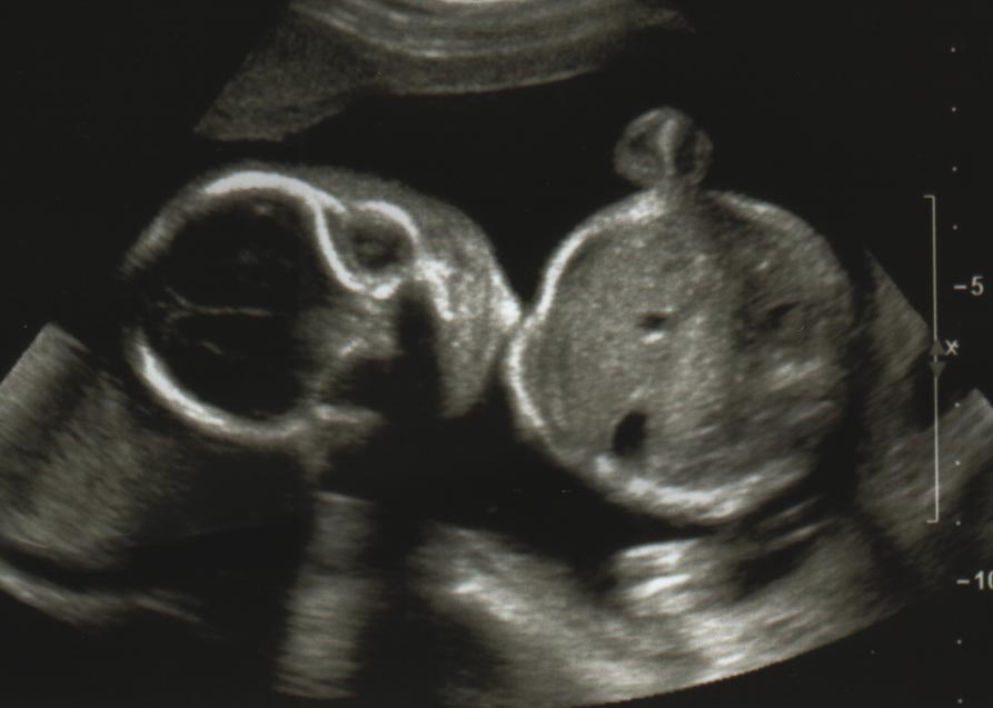 sonogram from January 12, 2005