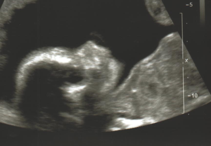 sonogram from January 12, 2005