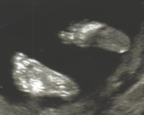 sonogram from January 12, 2005