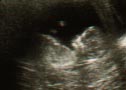 sonogram from November 11, 2004